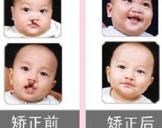 吃兔肉真的會(huì)長(zhǎng)兔唇？為什么會(huì)長(zhǎng)兔唇？
